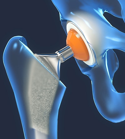 Function of a hip joint implant or hip prosthesis in frontal view - 3d illustration